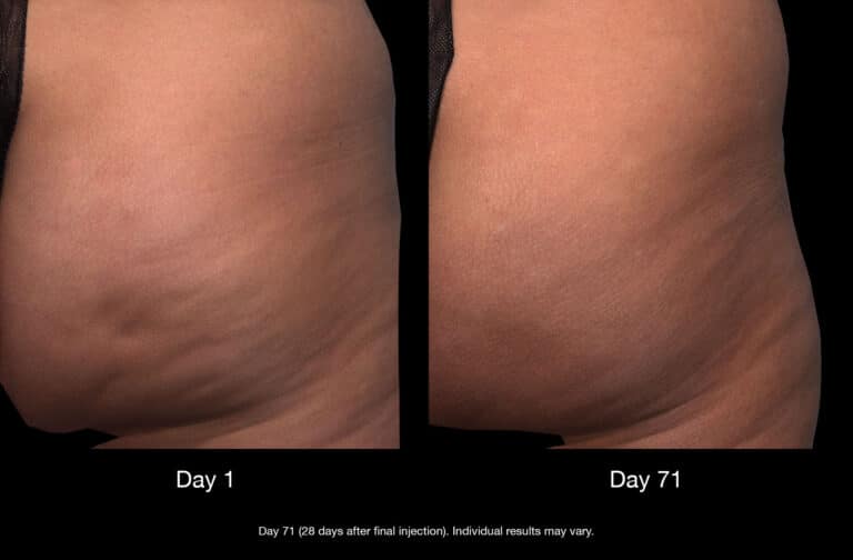 Before and after image comparing cellulite reduction results from Day 1 to Day 71.