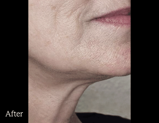 Before and After GIF of RF frequency on neck
