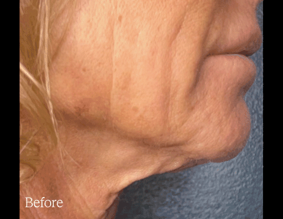 Before and After GIF of DENSITY RF treatment on womans neck