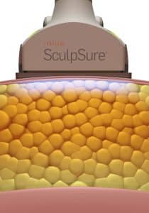 SculpSure step 2