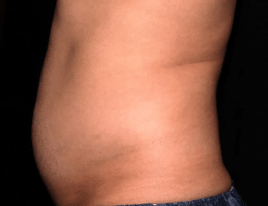 TruSculpt ID after picture of stomach - side view