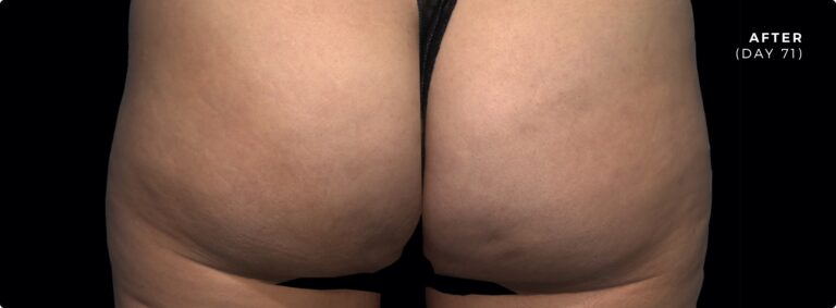 Close-up after treatment image showing reduced cellulite on the buttocks (Day 71).