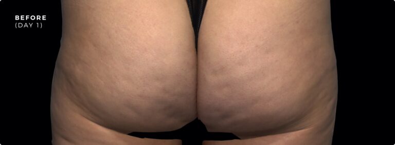 Close-up before treatment image showing cellulite on the buttocks (Day 1).