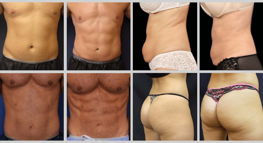 grid of before and after EmSculpt treatment on various body parts