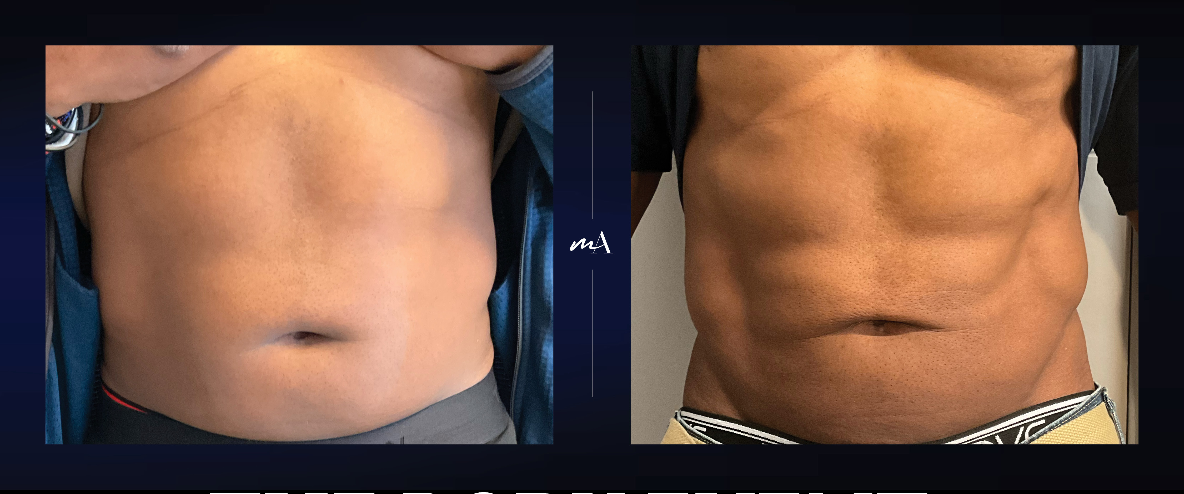 EmSculpt NEO before and after on abs at Manhattan Aesthetics
