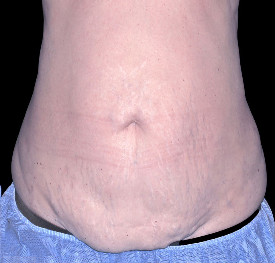 TruSculpt ID after picture of stomach - front view