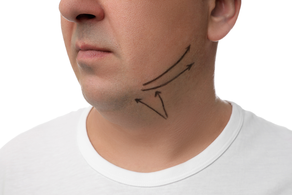 Man with markings on chin to show areas to lift