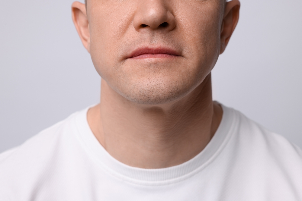 man after double chin treatment