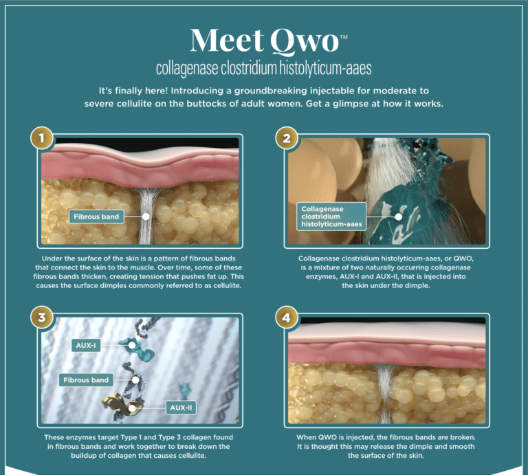 Infographic titled ‘Meet Qwo’ explaining how Qwo collagenase clostridium histolyticum-aaes works to treat cellulite, with step-by-step visuals showing fibrous bands, enzyme injection, collagen breakdown, and skin smoothing.