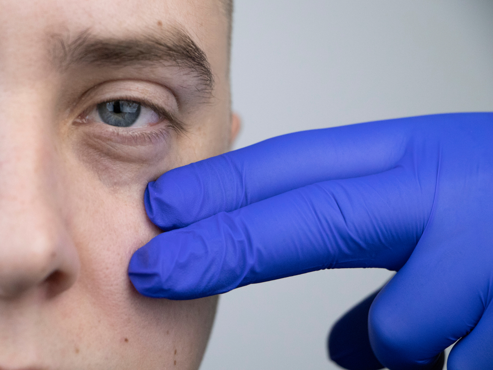 Man with sagging undereyes. Professional with gloves on inspecting the area.