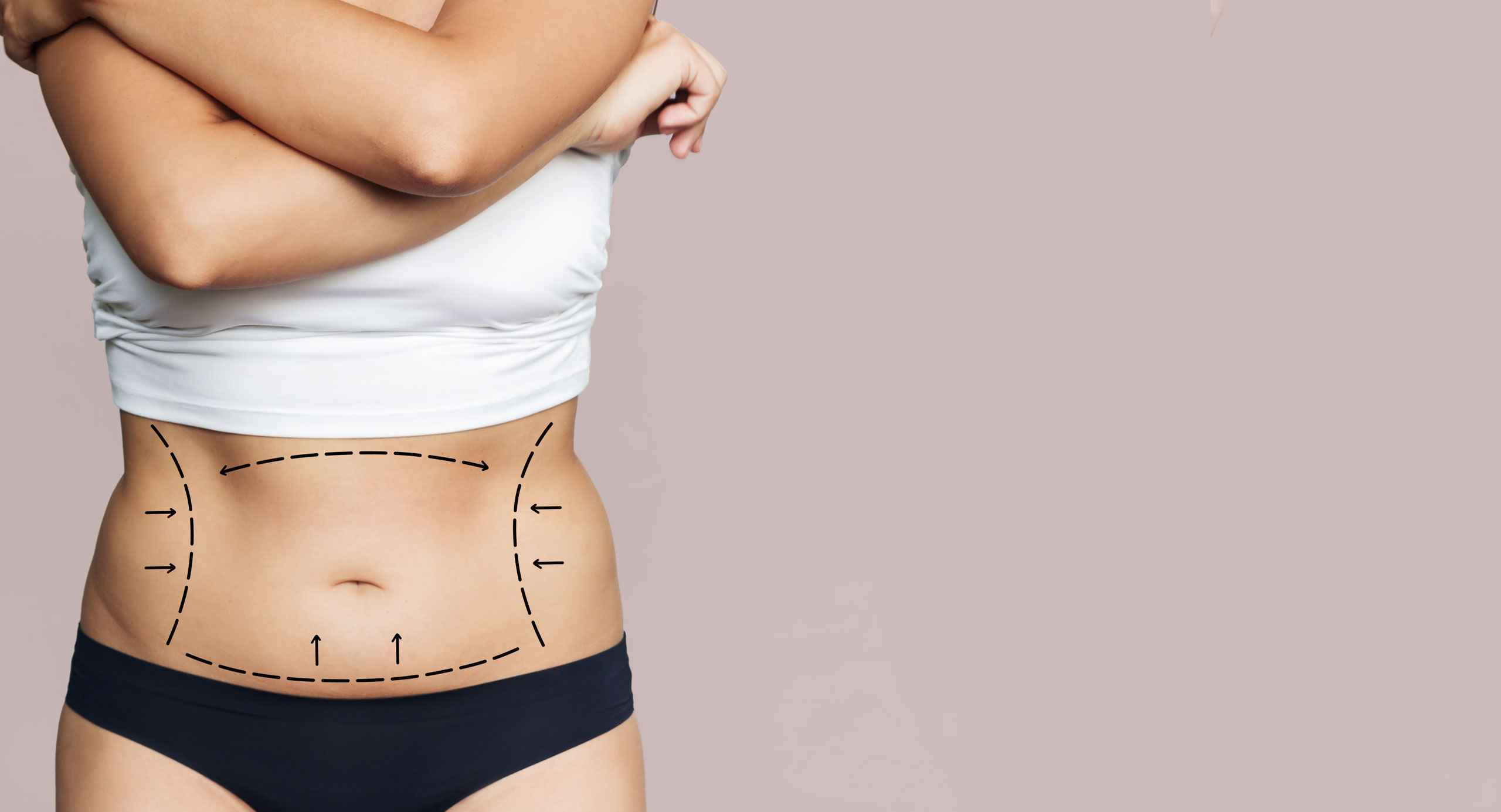 womans stomach with lines showing where loose skin has been treated