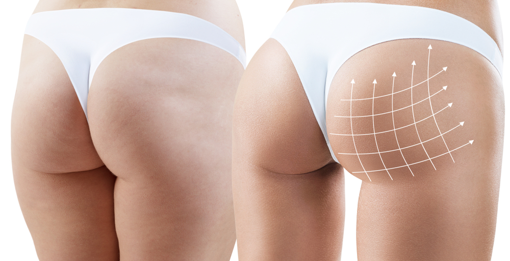 Sculptra butt lift before and after