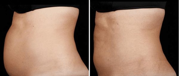 SculpSure Before & After New York City
