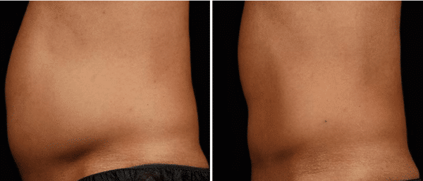 SculpSure Before & After New York City