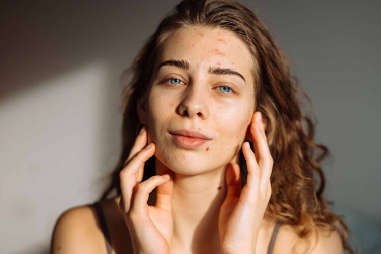 Acne Scars, Manhattan & New York City