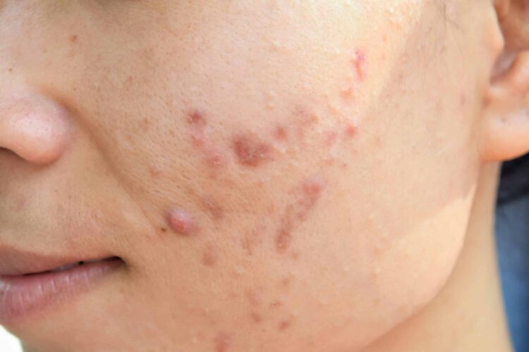 Acne Scars, Manhattan & New York City